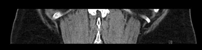 Buried bumper syndrome - gastrostomy tube (Radiopaedia 63843-72575 Coronal Inject 87).jpg