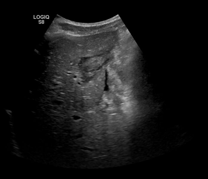 File:Burkitt lymphoma (bowel) (Radiopaedia 68839-78556 A 3).jpg