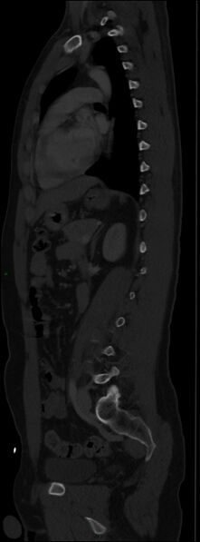File:Burst fracture (Radiopaedia 83168-97542 Sagittal bone window 78).jpg
