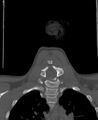 Butterfly vertebra (Radiopaedia 77903-90209 Coronal bone window 49).jpg