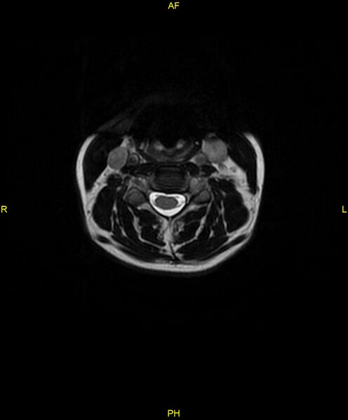 File:C5 nerve sheath tumor (Radiopaedia 85777-101596 Axial T2 26).jpg