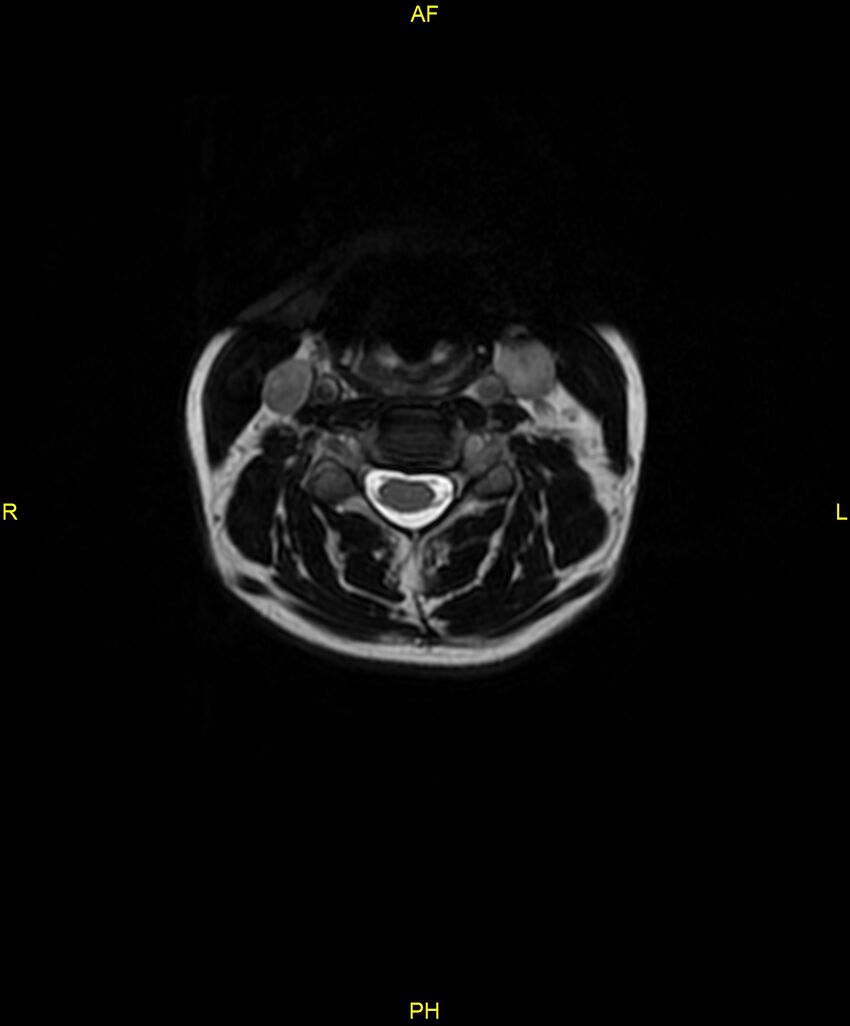 C5 nerve sheath tumor (Radiopaedia 85777-101596 Axial T2 26).jpg