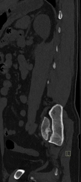 File:Calcaneal fractures with associated L2 burst fracture (Radiopaedia 71671-82493 Sagittal bone window 7).jpg
