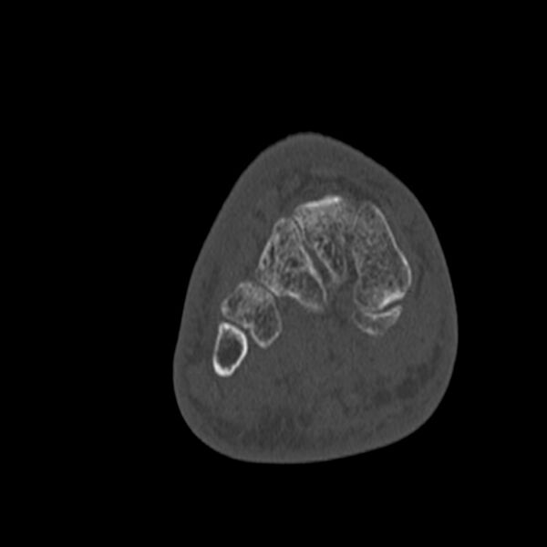 File:Calcaneal tuberosity avulsion fracture (Radiopaedia 22649-22668 Coronal bone window 36).jpg