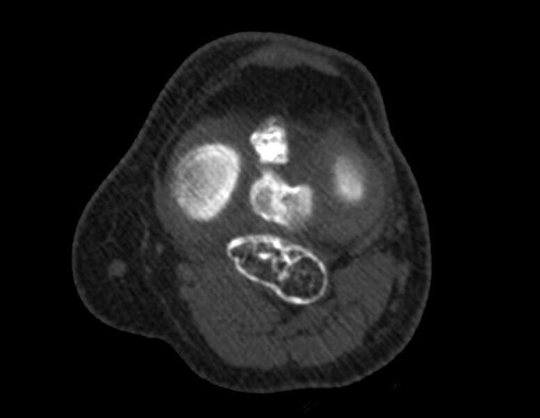File:Calcified hematoma - popliteal fossa (Radiopaedia 63938-72763 Axial bone window 23).jpg