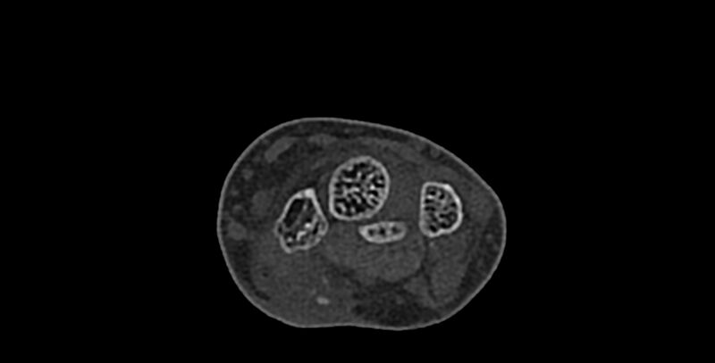 File:Calcifying aponeurotic fibroma (Radiopaedia 88423-105064 Axial bone window 68).jpg