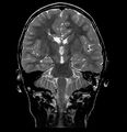Callosal dysgenesis and ectopic posterior pituitary (Radiopaedia 8382-9213 Coronal T2 1).jpg