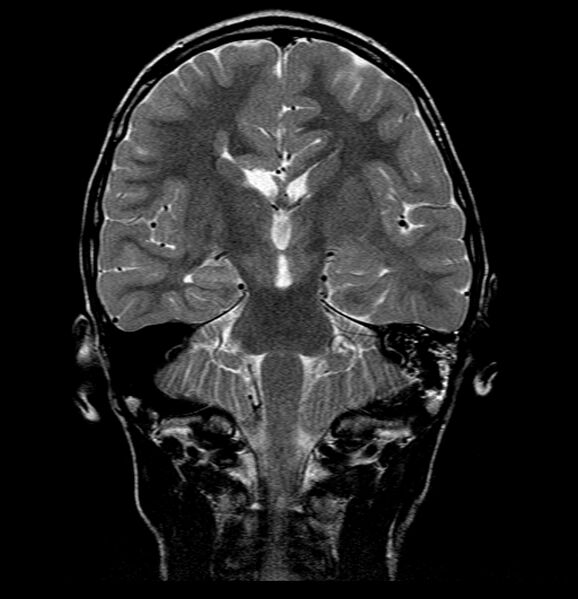 File:Callosal dysgenesis and ectopic posterior pituitary (Radiopaedia 8382-9213 Coronal T2 1).jpg