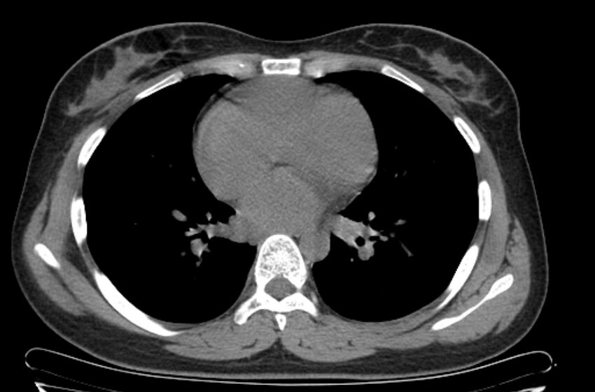 Cannonball metastases - uterine choriocarcinoma (Radiopaedia 70137-80173 Axial non-contrast 68).jpg