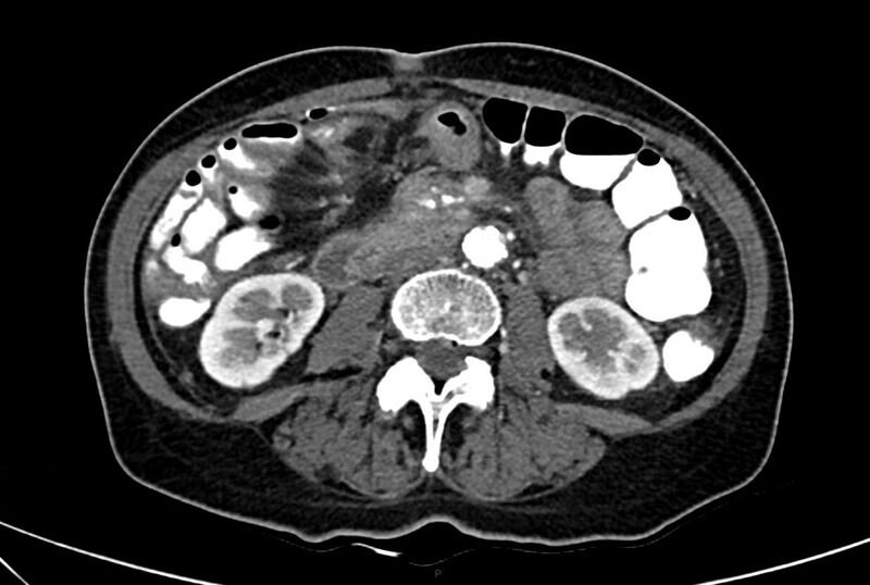 File:Carcinoid mesenteric tumor complicated by chylous ascites (Radiopaedia 76312-88926 A 36).jpg