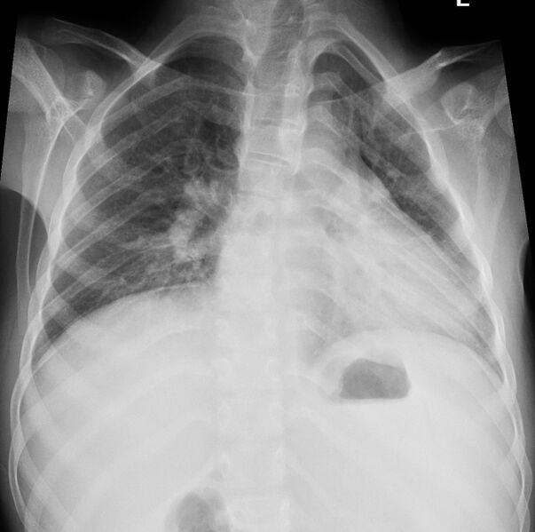 File:Cardiac bronchus (Radiopaedia 14059-13898 Frontal 1).jpg