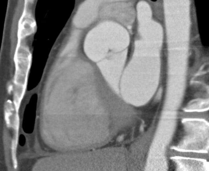 File:Cardiac hemangioma (Radiopaedia 16971-16679 C 11).JPG
