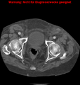 Cardiac perforation following transcatheter aortic valve implantation (Radiopaedia 23714-23863 B 7).png