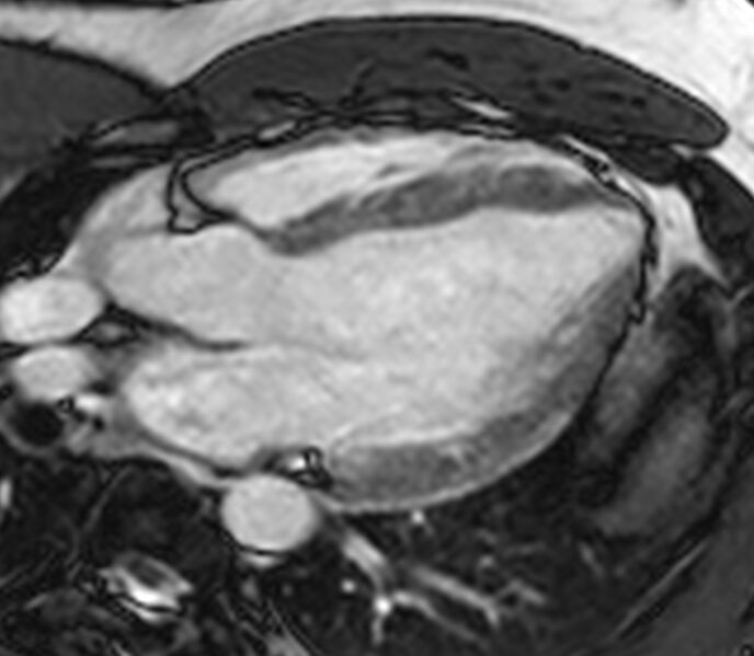 File:Cardiac sarcoidosis (Radiopaedia 39811-42243 LVOT cine images 25).jpg