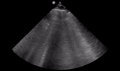 Cardiogenic pulmonary edema (ultrasound) (Radiopaedia 62735-71050 B 1).gif