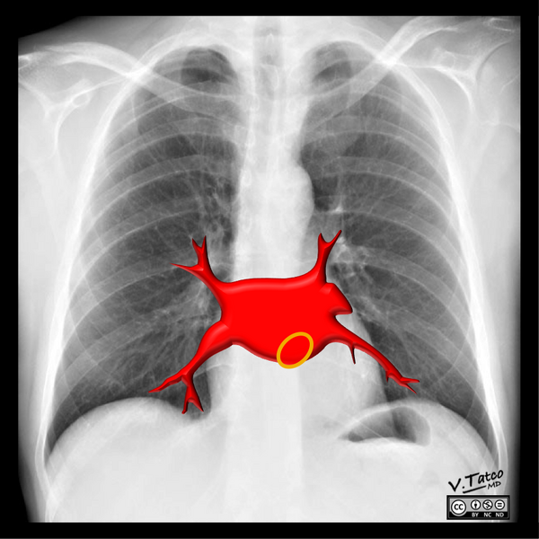 File:Cardiomediastinal anatomy on chest radiography (annotated images) (Radiopaedia 46331-50742 I 1).png