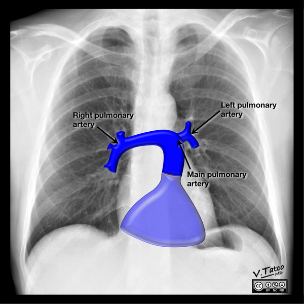 File:Cardiomediastinal anatomy on chest radiography (annotated images) (Radiopaedia 46331-50742 Q 4).png