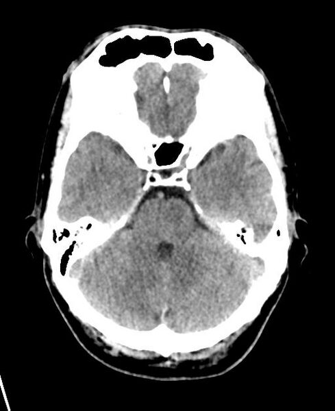 File:Carotid arterial dissection (Radiopaedia 30001-30549 Axial non-contrast 12).jpg