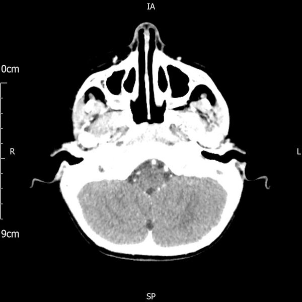 File:Cavernous sinus thrombosis (Radiopaedia 79414-92510 Axial Brain 58).jpg