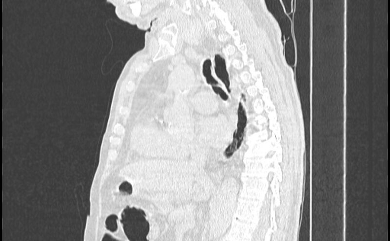 File:Cavitating bronchogenic carcinoma (Radiopaedia 44489-48162 Sagittal lung window 28).jpg