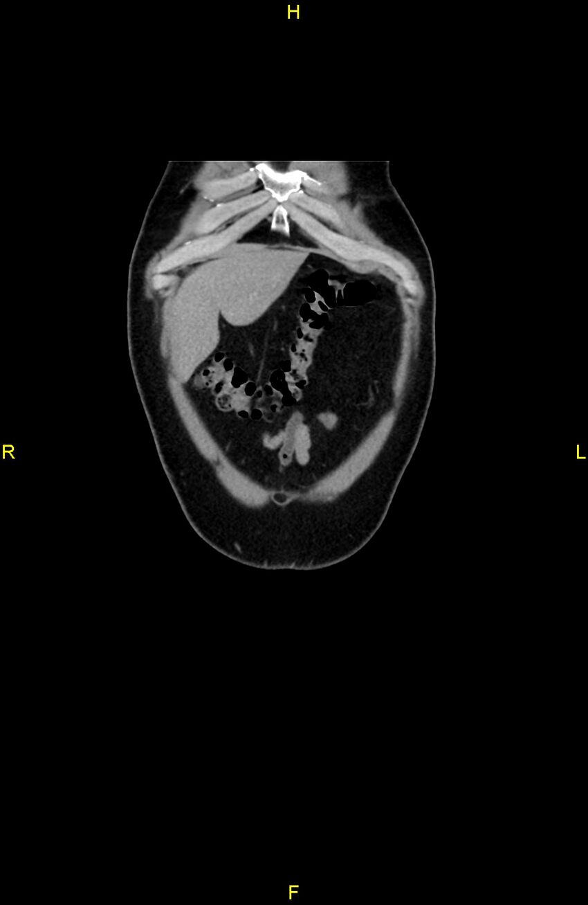 Cecal epiploic appendagitis (Radiopaedia 86047-102164 B 10).jpg