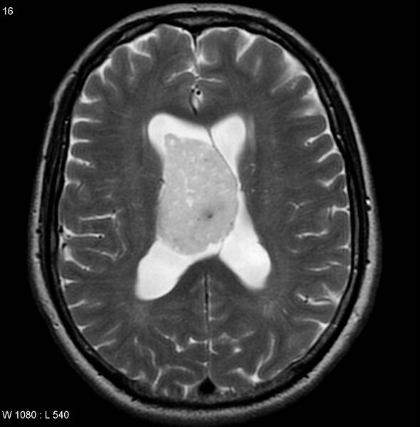 File:Central neurocytoma (Radiopaedia 4956-6850 Axial T2 1).jpg