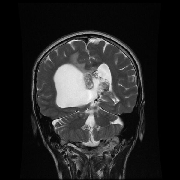 File:Central neurocytoma (Radiopaedia 67618-77021 Coronal T2 14).jpg