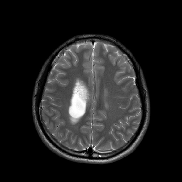 File:Central neurocytoma (Radiopaedia 79320-92380 Axial T2 20).jpg