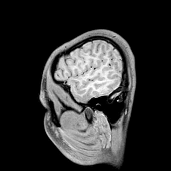 File:Central neurocytoma (Radiopaedia 79320-92380 Sagittal T1 42).jpg