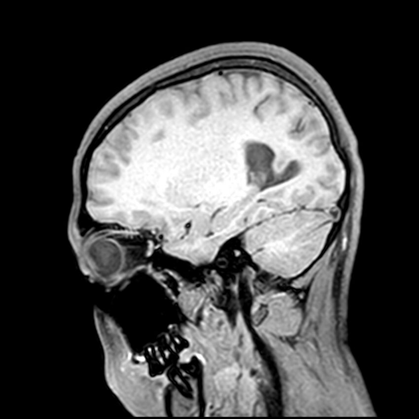 Central neurocytoma (Radiopaedia 79320-92380 Sagittal T1 84).jpg