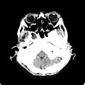 Cerebellar abscess secondary to mastoiditis (Radiopaedia 26284-26412 Axial non-contrast 22).jpg