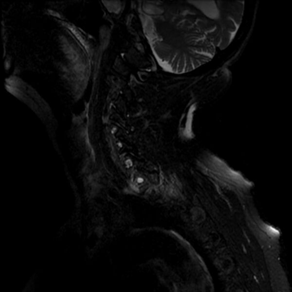 File:Cerebellar ataxia with neuropathy and vestibular areflexia syndrome (CANVAS) (Radiopaedia 74283-85159 Sagittal T2 fat sat 10).jpg