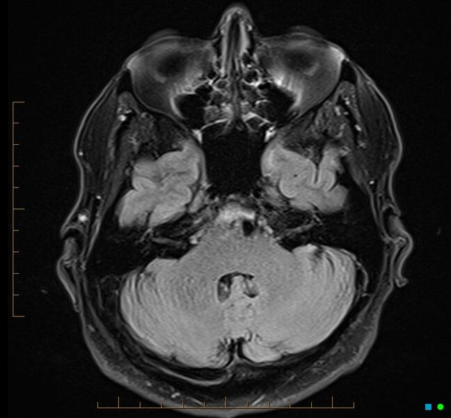 File:Cerebellar gangliocytoma (Radiopaedia 65377-74422 Axial FLAIR 9).jpg