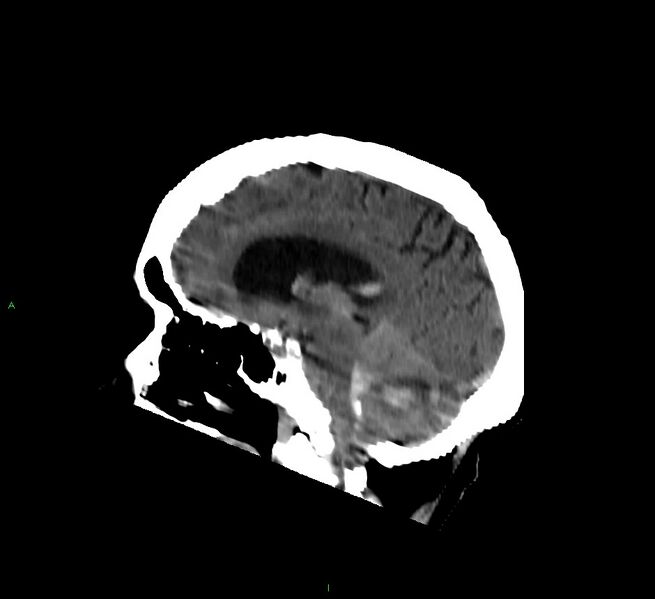 File:Cerebellar hemorrhage (Radiopaedia 58792-66026 C 28).jpg