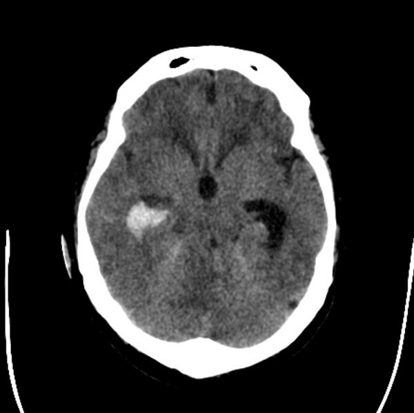 File:Cerebellar hemorrhage causing obstructive hydrocephalus (Radiopaedia 33989-35207 Axial non-contrast 19).jpg