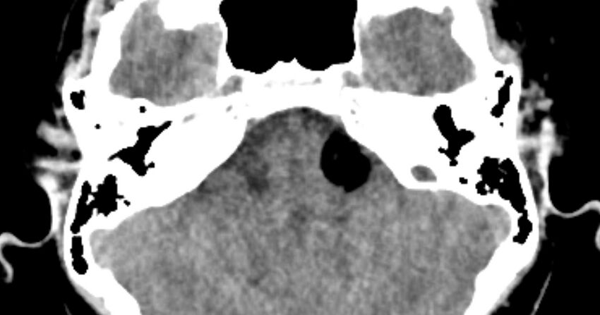 Cerebellopontine angle lipoma (Radiopaedia 57303-64242 B 28).jpg