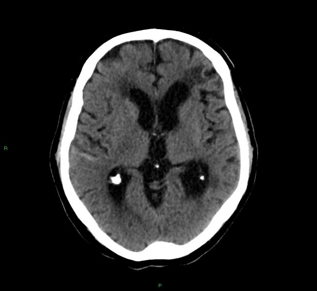 File:Cerebral amyloid angiopathy-associated lobar intracerebral hemorrhage (Radiopaedia 58376-65513 Axial non-contrast 28).jpg