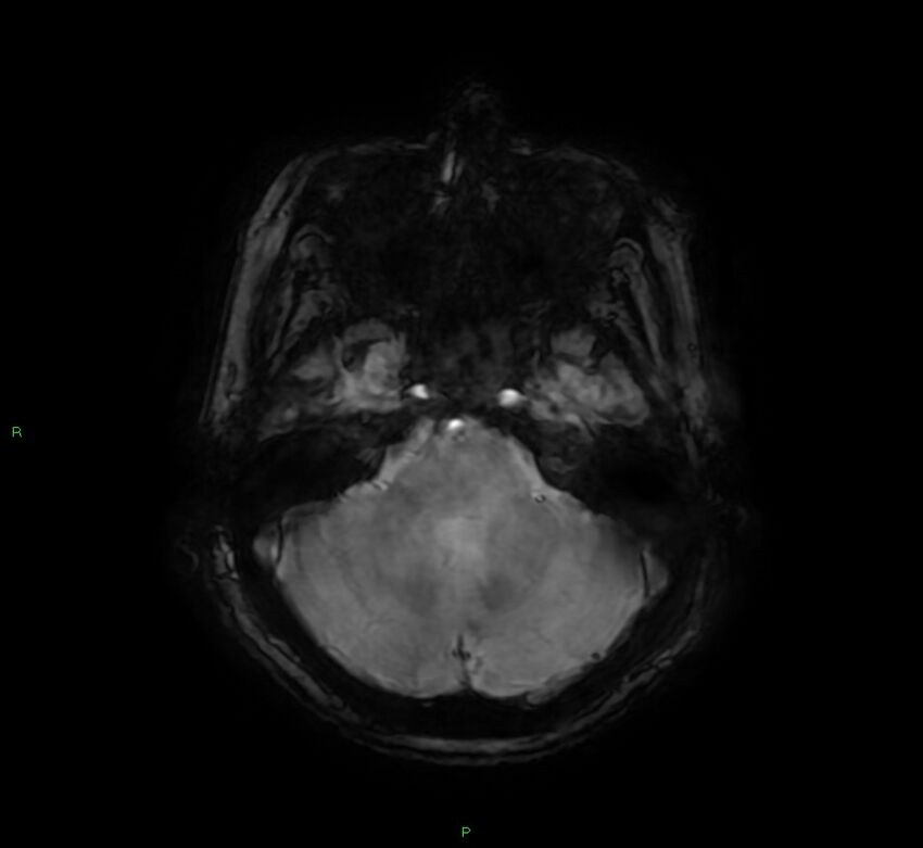 Cerebral amyloid angiopathy-associated lobar intracerebral hemorrhage (Radiopaedia 58378-65517 Axial SWI 18).jpg