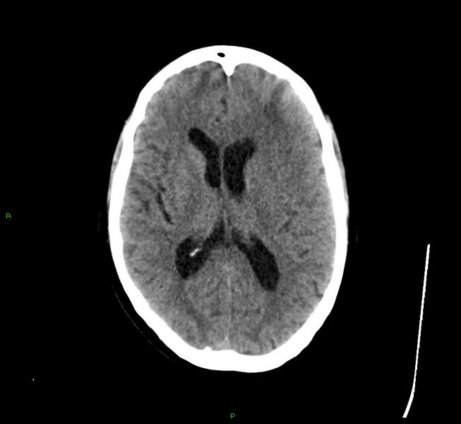 File:Cerebral amyloid angiopathy-associated lobar intracerebral hemorrhage (Radiopaedia 58529-65681 Axial non-contrast 25).jpg