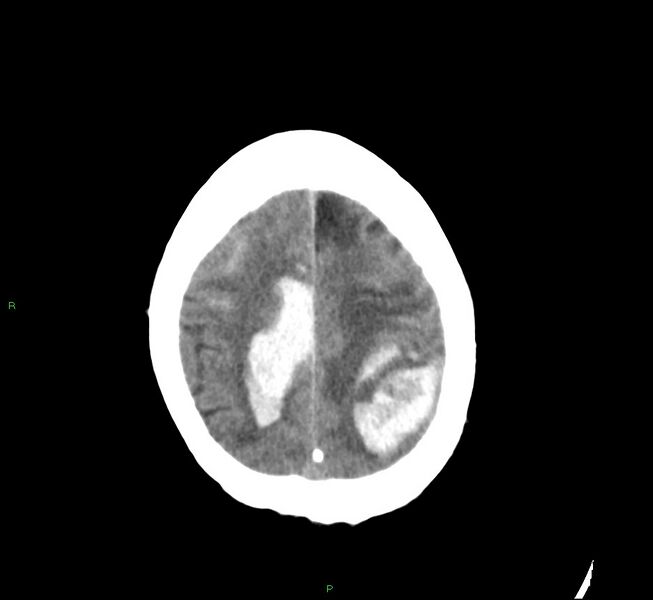 File:Cerebral amyloid angiopathy-associated lobar intracerebral hemorrhage (Radiopaedia 58529-65686 Axial non-contrast 22).jpg
