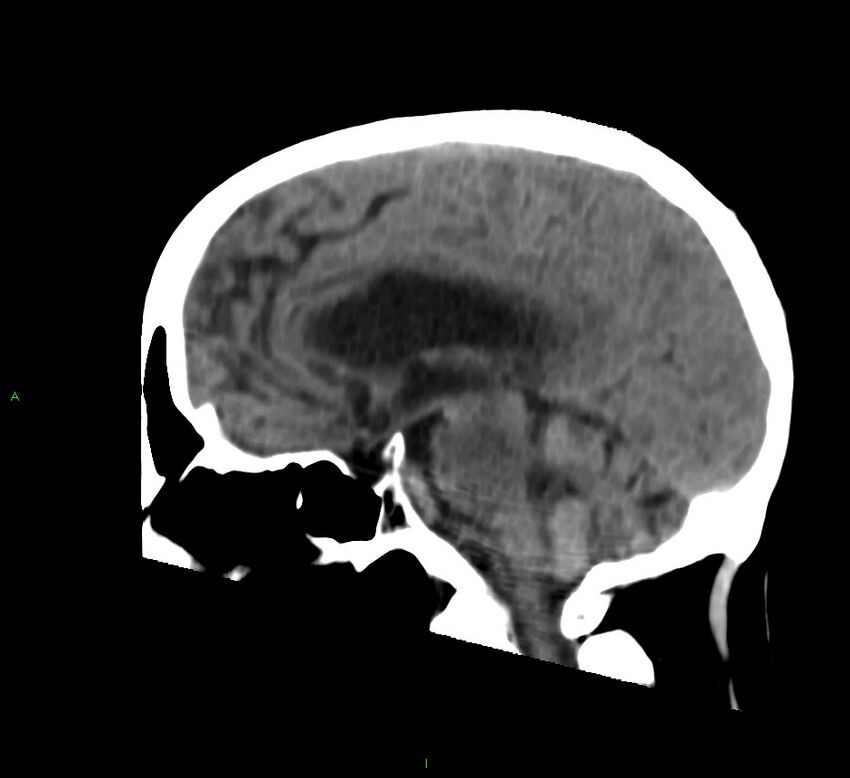 Cerebral amyloid angiopathy-associated lobar intracerebral hemorrhage (Radiopaedia 58530-65688 C 26).jpg