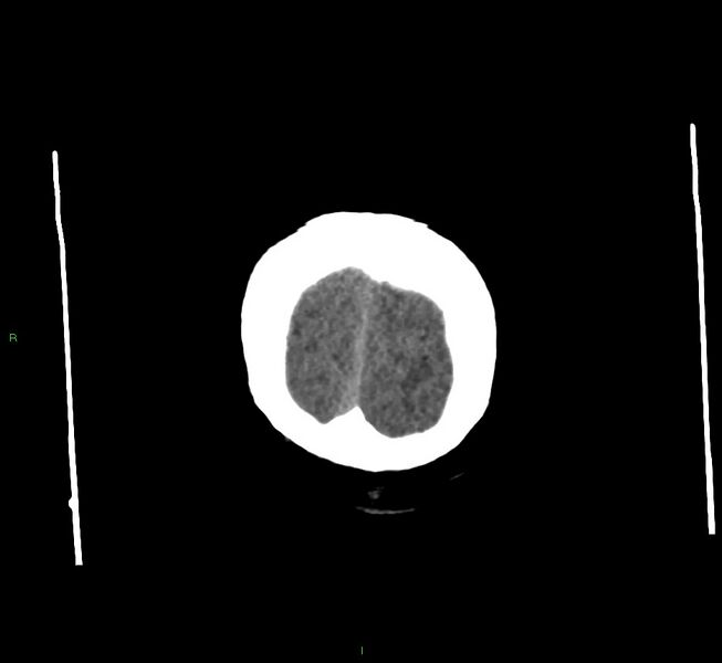 File:Cerebral amyloid angiopathy-associated lobar intracerebral hemorrhage (Radiopaedia 58560-65723 Coronal non-contrast 7).jpg