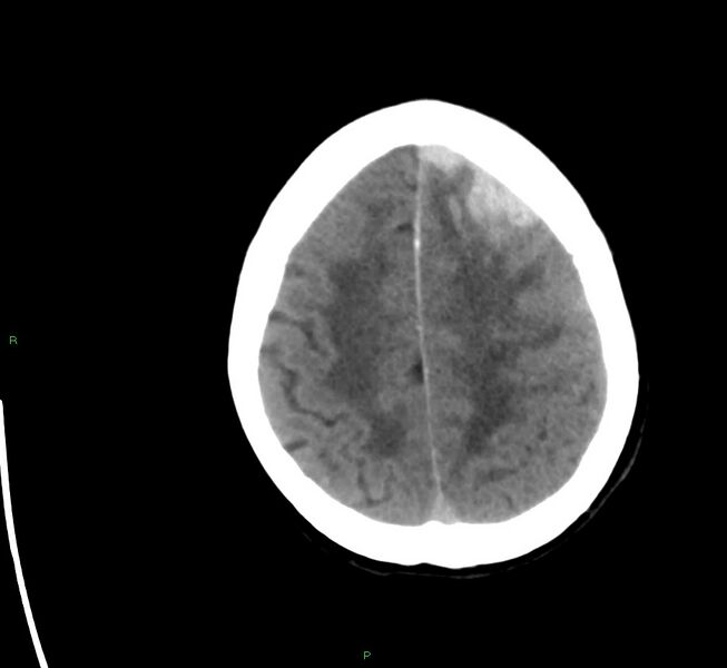 File:Cerebral amyloid angiopathy-associated lobar intracerebral hemorrhage (Radiopaedia 58561-65724 Axial non-contrast 10).jpg