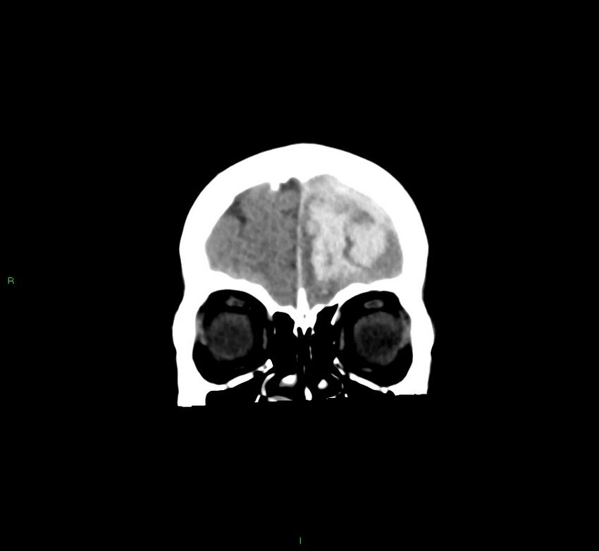 Cerebral amyloid angiopathy-associated lobar intracerebral hemorrhage (Radiopaedia 58561-65724 Coronal non-contrast 52).jpg