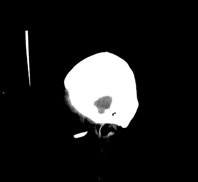 File:Cerebral amyloid angiopathy-associated lobar intracerebral hemorrhage (Radiopaedia 58566-65730 C 4).jpg
