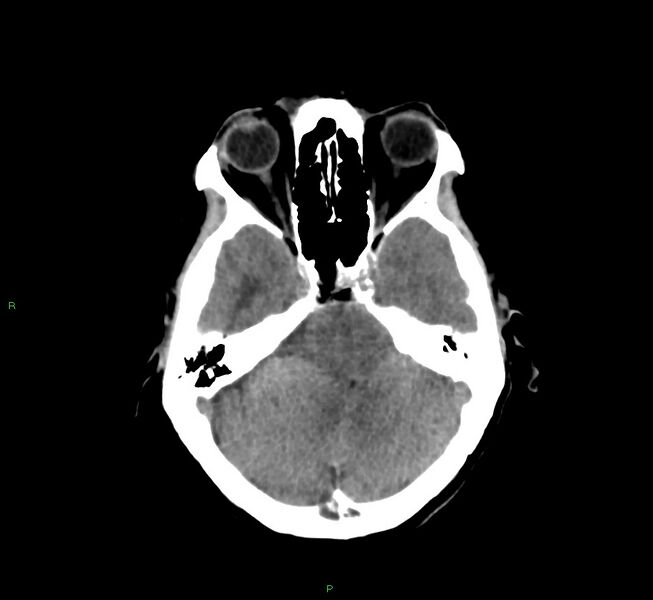 File:Cerebral amyloid angiopathy-associated lobar intracerebral hemorrhage (Radiopaedia 58751-65972 Axial non-contrast 36).jpg