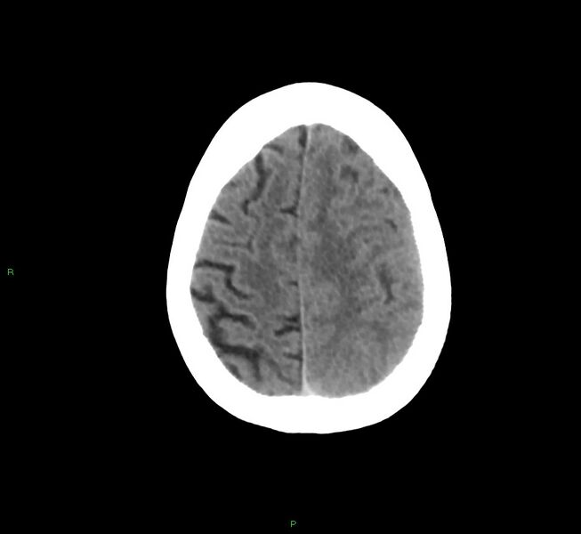 File:Cerebral amyloid angiopathy-associated lobar intracerebral hemorrhage (Radiopaedia 58754-65975 Axial non-contrast 19).jpg