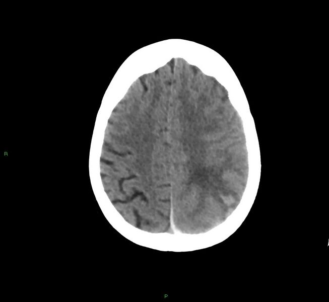 File:Cerebral amyloid angiopathy-associated lobar intracerebral hemorrhage (Radiopaedia 58754-65975 Axial non-contrast 22).jpg