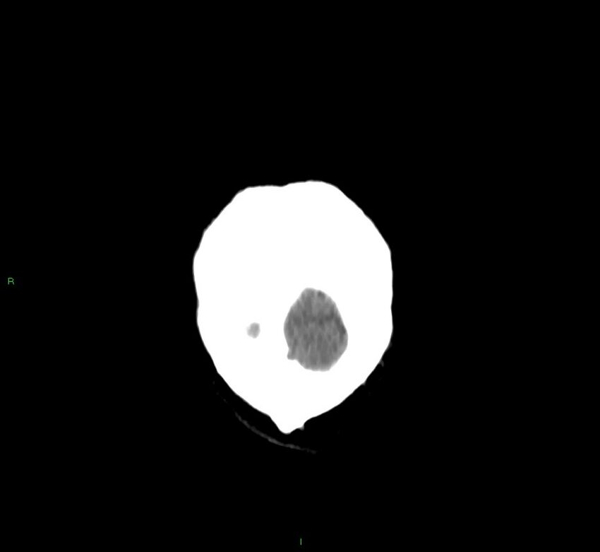 Cerebral amyloid angiopathy-associated lobar intracerebral hemorrhage (Radiopaedia 58756-65977 Coronal non-contrast 6).jpg
