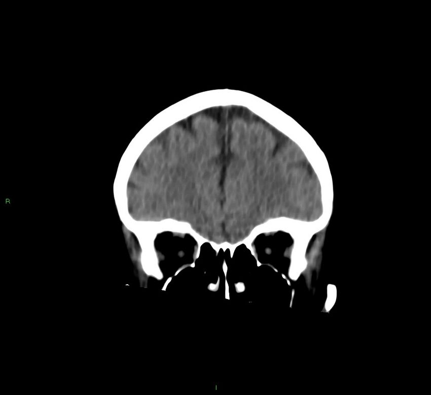 Cerebral amyloid angiopathy-associated lobar intracerebral hemorrhage (Radiopaedia 58757-65978 Coronal non-contrast 52).jpg